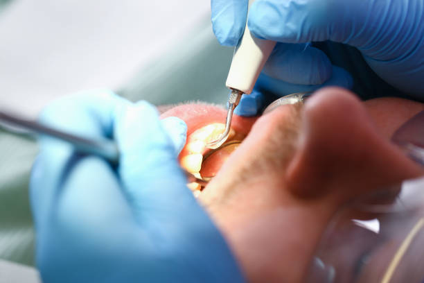 Best Emergency Wisdom Teeth Removal in Tipton, IN