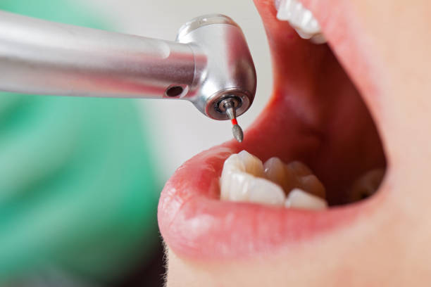 Best Emergency Tooth Extraction in Tipton, IN